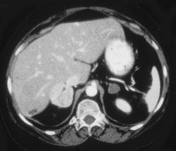 Pheochromocytoma of Right Adrenal Gland; Adenoma of Left Adrenal Gland - CTisus CT Scan