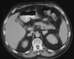 Adrenal Histoplasmosis - CTisus CT Scan