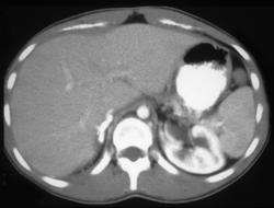 Calcified Adrenals - CTisus CT Scan