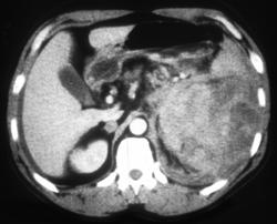 Adrenal Hemorrhage Due to Metastases - CTisus CT Scan