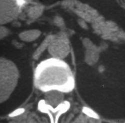 Cushings Disease - CTisus CT Scan