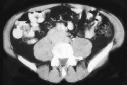 Extra-adrenal Pheochromocytoma - CTisus CT Scan
