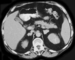 Histoplasmosis - CTisus CT Scan