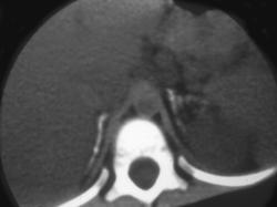 Wolmans Disease - CTisus CT Scan