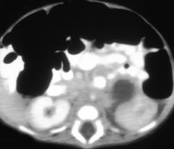 Hemorrhage Into the Adrenal in A Newborn - CTisus CT Scan