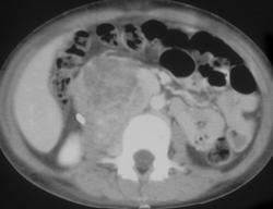 Extra-adrenal Neuroblastoma - CTisus CT Scan