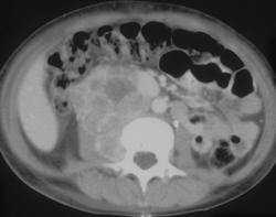 Extra-adrenal Neuroblastoma (part Ii) - CTisus CT Scan