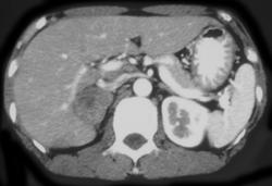 Adrenal Ganglioneuroma - CTisus CT Scan