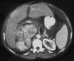IVC Sarcoma Simulates An Adrenal Mass - CTisus CT Scan
