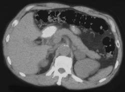 Aldosteronoma - CTisus CT Scan