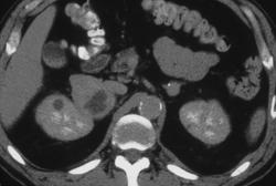 Right Adrenal Pheochromocytoma and Left Adrenal Adenoma - CTisus CT Scan