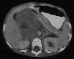 Neuroblastoma - CTisus CT Scan