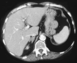 Bilateral Adrenal Hyperplasia - CTisus CT Scan