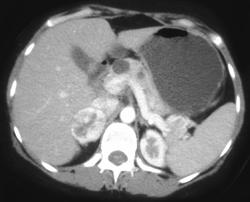 Right Adrenal Pheochromocytoma and Islet Cell Tumor of the Distal Pancreas - CTisus CT Scan