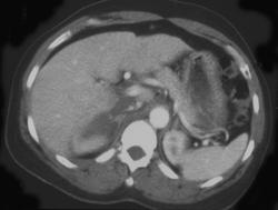 Right Adrenal Hemorrhage - CTisus CT Scan