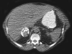 Old Calcified Adrenal Hematoma - CTisus CT Scan
