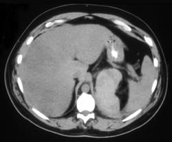 Left Adrenal Hemorrhage - CTisus CT Scan