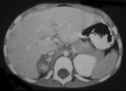Adrenal Hemorrhage - CTisus CT Scan