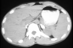 Adrenal Calcifications Due to Prior Granulomatous Disease - CTisus CT Scan