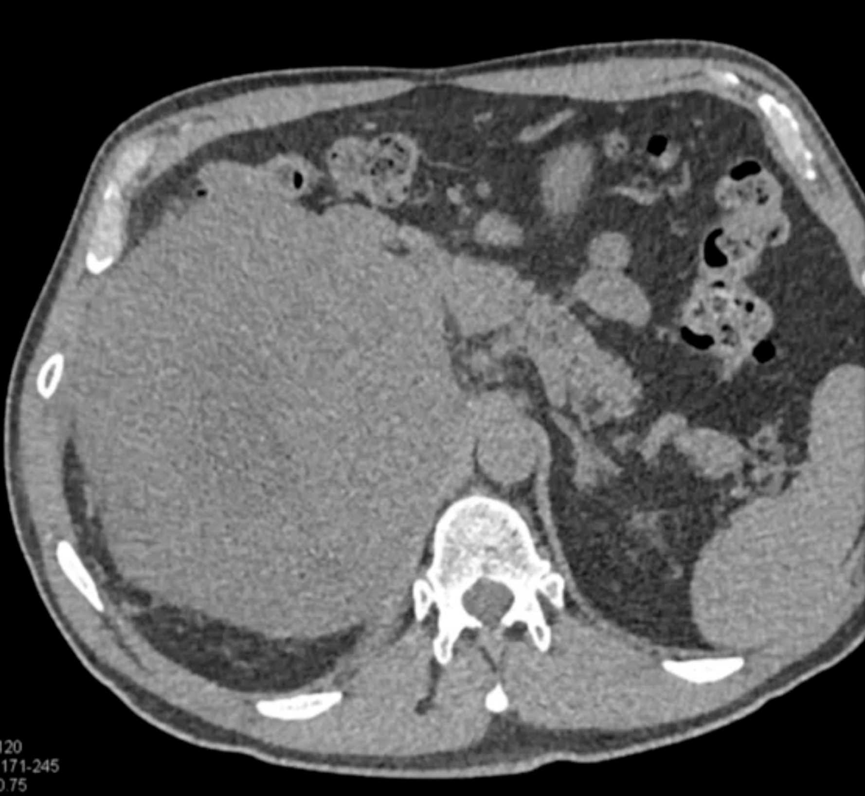 Pleomorphic Sarcoma of the Adrenal - CTisus CT Scan