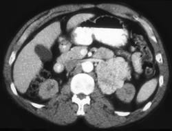 Ganglioneuroma - CTisus CT Scan