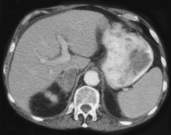 Adrenal Metastasis - CTisus CT Scan