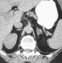 Left Adrenal Adenoma - CTisus CT Scan