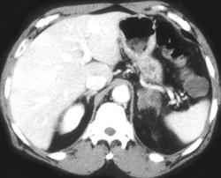 Lung Cancer With Adrenal Metastasis - CTisus CT Scan