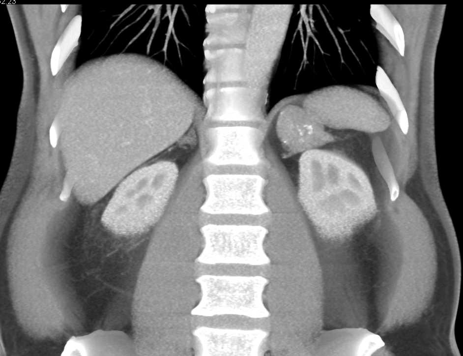 Lipid Poor Myelolipoma of the Left Adrenal - CTisus CT Scan
