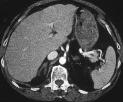 Mild Adrenal Hyperplasia - CTisus CT Scan