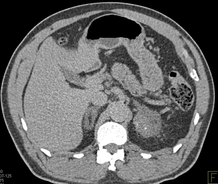 Lipid Poor Myelolipoma of the Left Adrenal - CTisus CT Scan