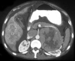 Hepatoma Metastatic to the Adrenal Gland - CTisus CT Scan