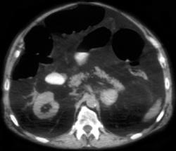 Bilateral Adrenal Hemorrhage (icu Patient) - CTisus CT Scan
