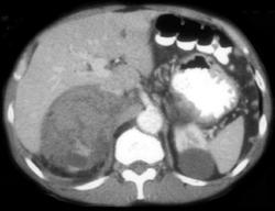 Spontaneous Bleed in Metastasis to the Right Adrenal (lung Cancer) - CTisus CT Scan