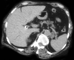 Adenoma - CTisus CT Scan