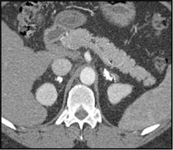 Tuberculosis (TB) of the Adrenal Gland - CTisus CT Scan