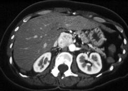 Ectopic Pheochromocytoma - CTisus CT Scan