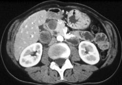 Metastatic Lung Cancer With Adrenal Pancreatic Intraductal Papillary Mucinous Neoplasm (IPMN) Also Seen - CTisus CT Scan