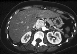 Ectopic Hypervascular Pheochromocytoma - CTisus CT Scan