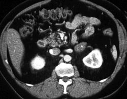 Incidental Left Adrenal Myelolipoma in Patient With Sickle Cell Disease - CTisus CT Scan