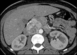 Ectopic Heochromocytoma - CTisus CT Scan