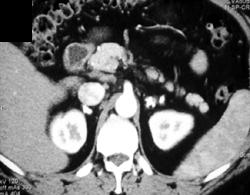 Calcified Adrenals Due to Tuberculosis (TB) - CTisus CT Scan