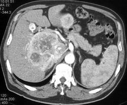 Adrenal Carcinoma - CTisus CT Scan