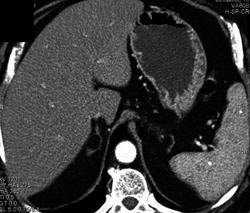 Myelolipoma - CTisus CT Scan