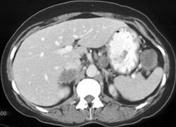Metastatic Melanoma - CTisus CT Scan
