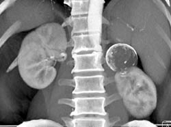 Calcified Adrenal Hematoma - CTisus CT Scan