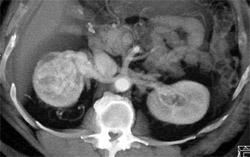 Adrenal Metastases From Renal Carcinoma - CTisus CT Scan