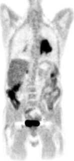 Lung Cancer Metastatic to Right Adrenal on PET - CTisus CT Scan