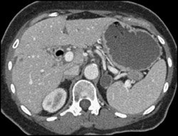 Gastric Pseudo-adrenal Lesion - CTisus CT Scan
