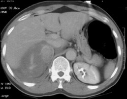 Bleed From Metastatic Lung Cancer to Right Adrenal - CTisus CT Scan